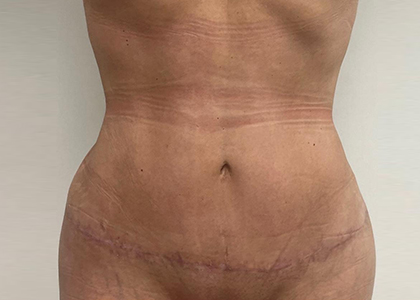 Liposuction & Mini Tummy Tuck