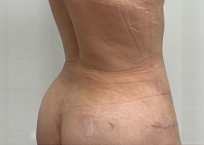 Liposuction & Mini Tummy Tuck