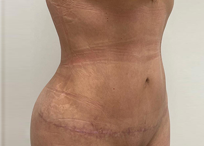 Liposuction & Mini Tummy Tuck