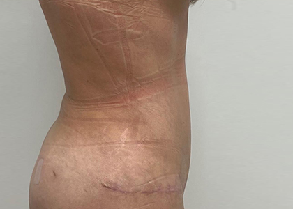 Liposuction & Mini Tummy Tuck