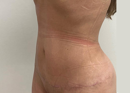 Liposuction & Mini Tummy Tuck