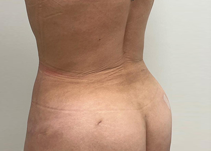 Liposuction & Mini Tummy Tuck