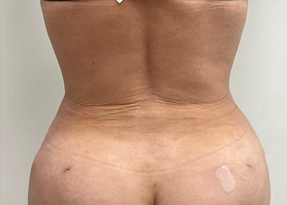 Liposuction & Mini Tummy Tuck