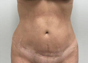 Le Spa Plastic Surgery Before and After Photos
