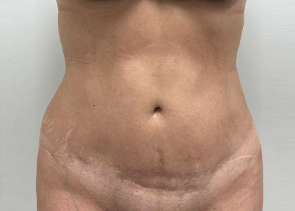 Liposuction & Mini Tummy Tuck