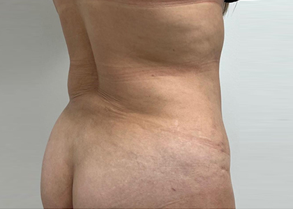 Liposuction & Mini Tummy Tuck