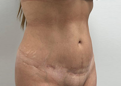 Liposuction & Mini Tummy Tuck