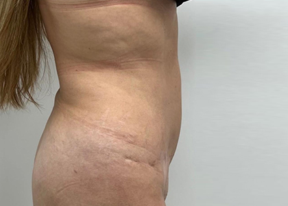 Liposuction & Mini Tummy Tuck