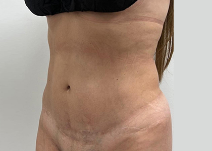 Liposuction & Mini Tummy Tuck