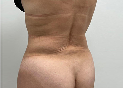Liposuction & Mini Tummy Tuck