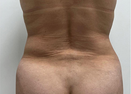 Liposuction & Mini Tummy Tuck