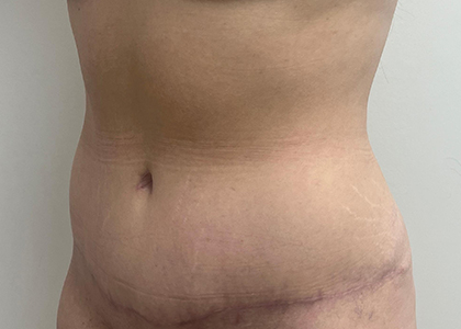 Tummy Tuck