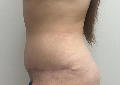 Tummy Tuck