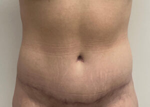 Le Spa Plastic Surgery Before and After Photos