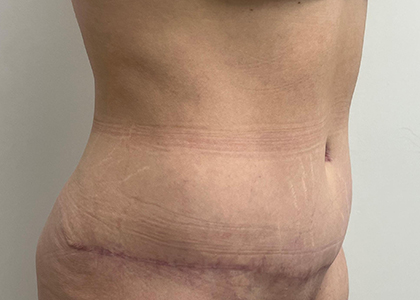 Tummy Tuck