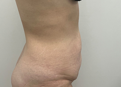 Tummy Tuck