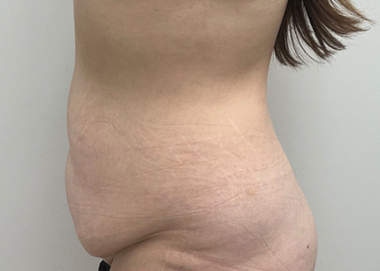 Tummy Tuck
