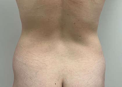 Tummy Tuck