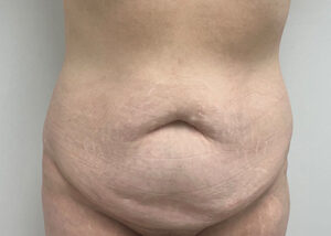 Le Spa Plastic Surgery Before and After Photos