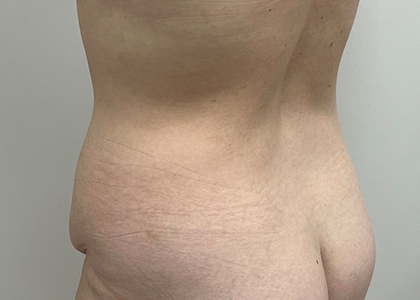 Tummy Tuck