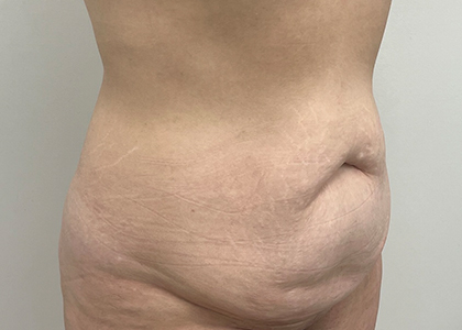 Tummy Tuck