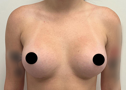 Breast Augmentation