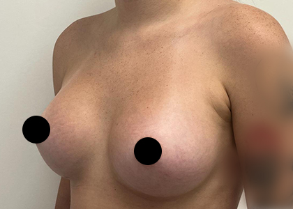 Breast Augmentation