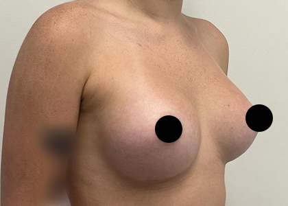 Breast Augmentation
