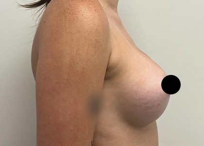 Breast Augmentation