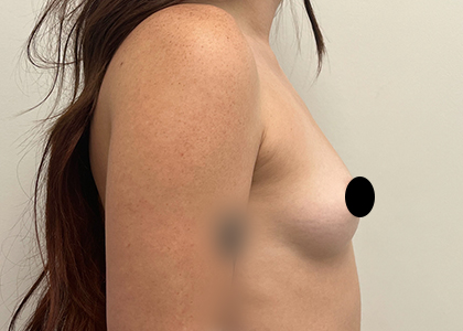 Breast Augmentation