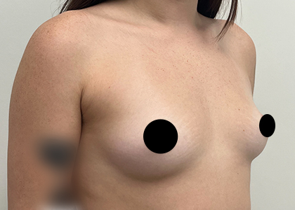 Breast Augmentation