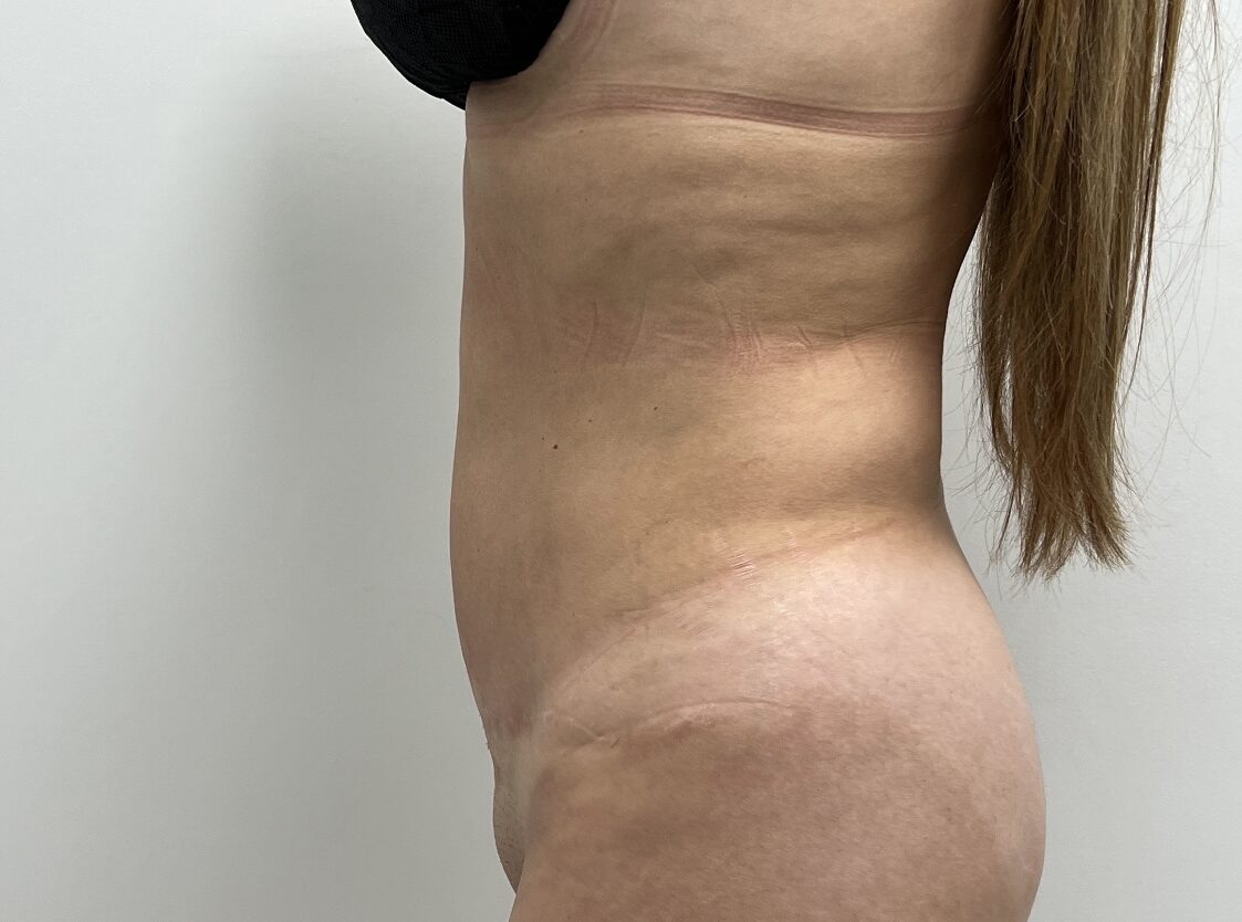 Liposuction & Mini Tummy Tuck
