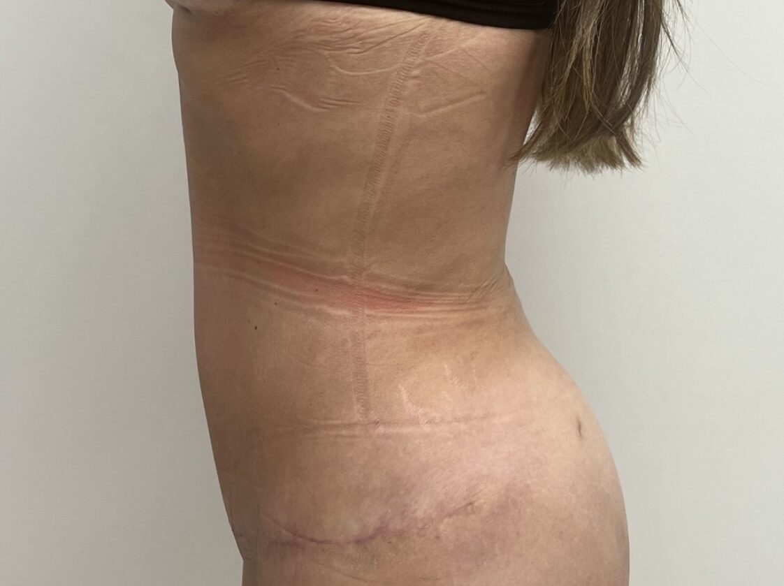 Liposuction & Mini Tummy Tuck