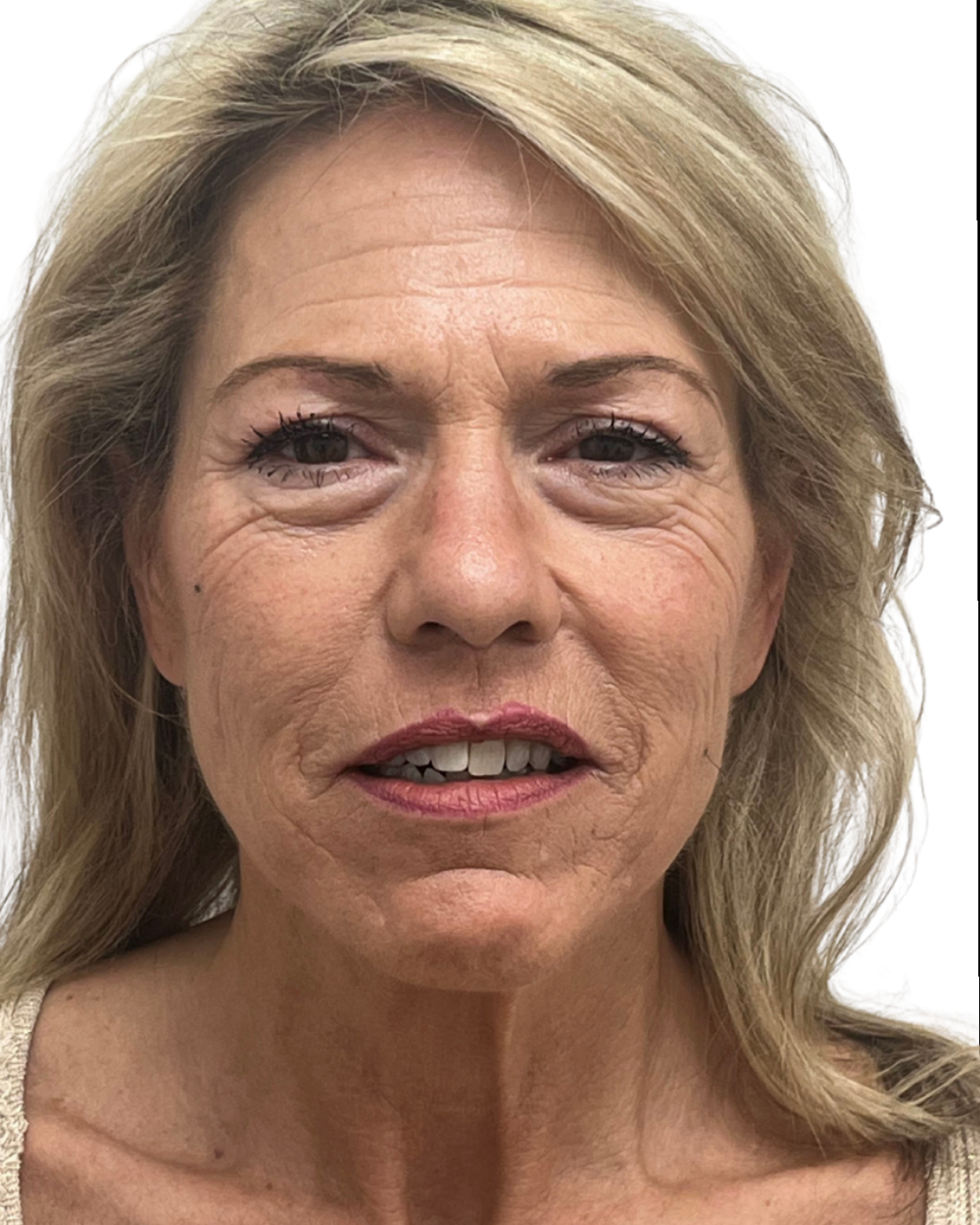 Facelift with Upper & Lower Bleph