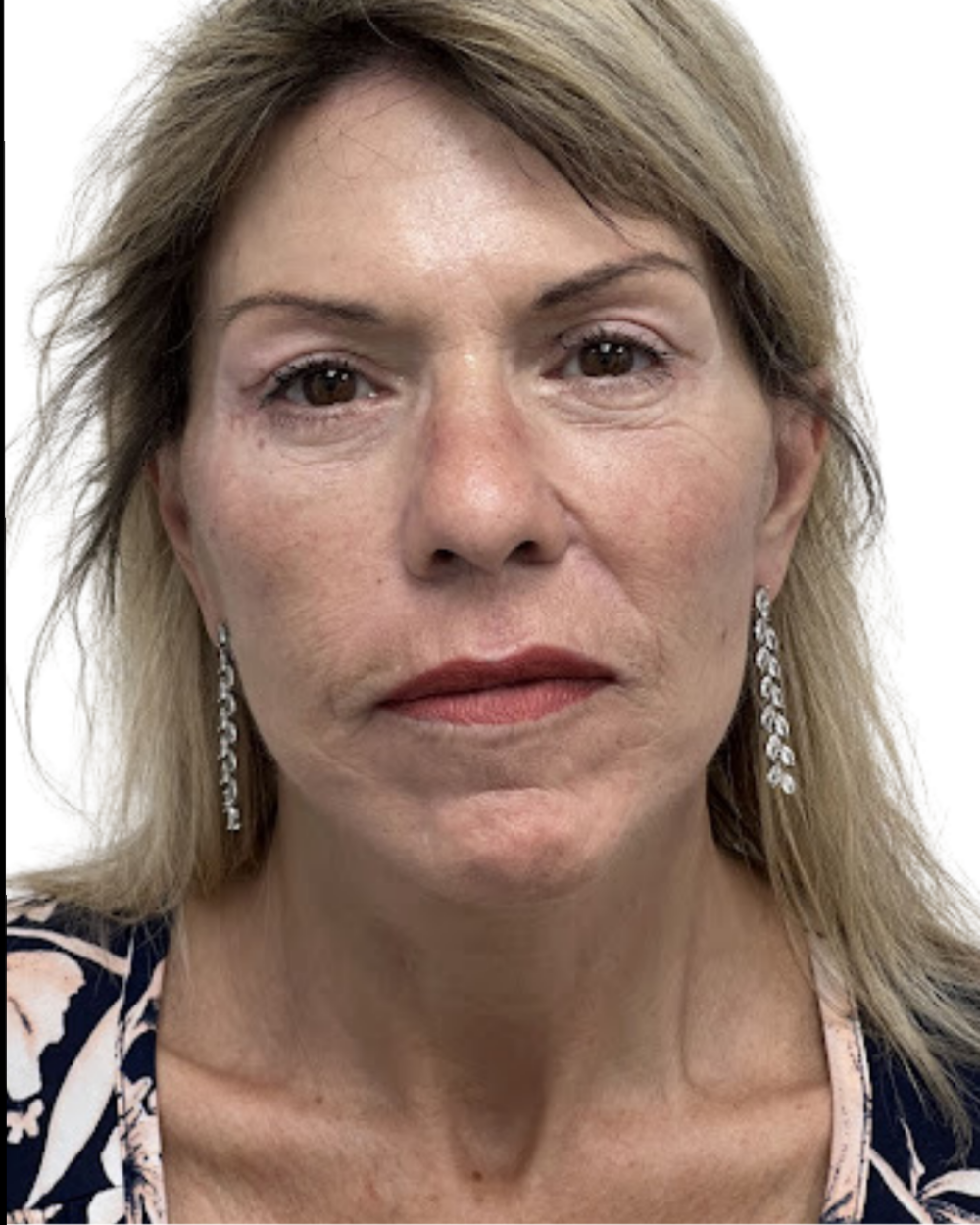 Facelift with Upper & Lower Bleph