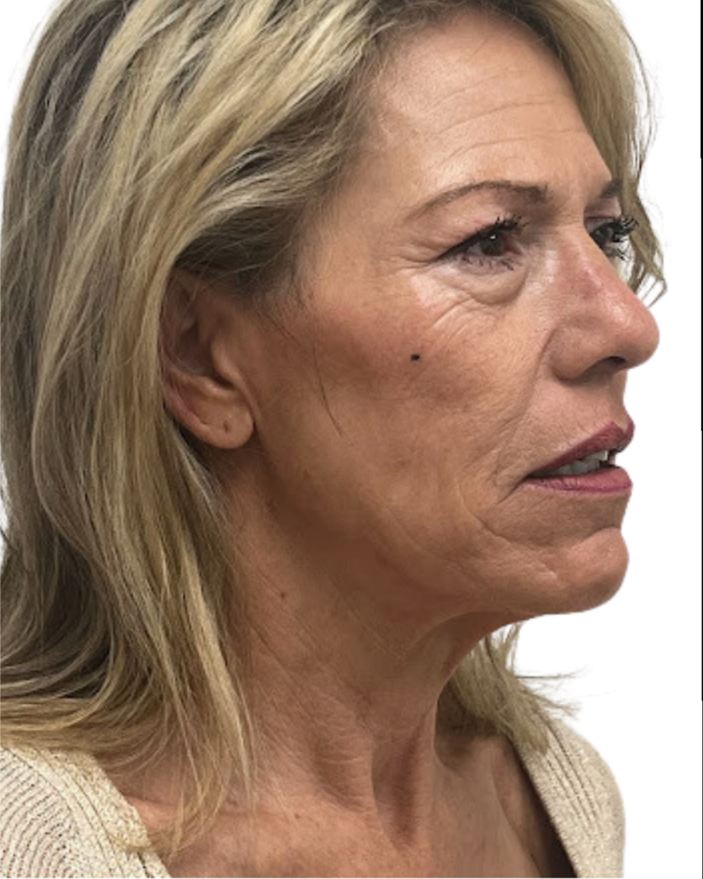 Facelift with Upper & Lower Bleph