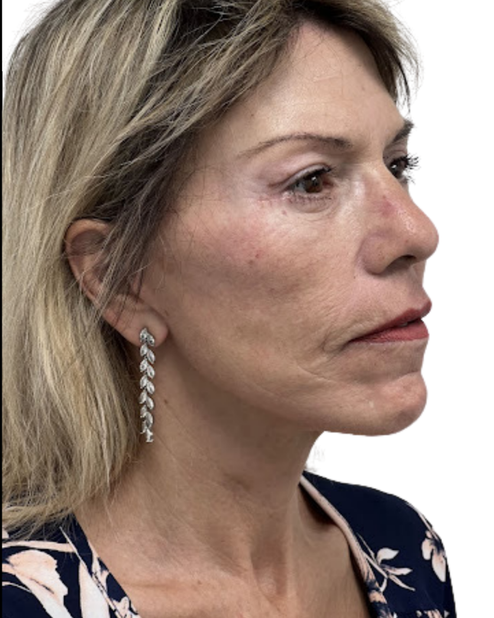 Facelift with Upper & Lower Bleph