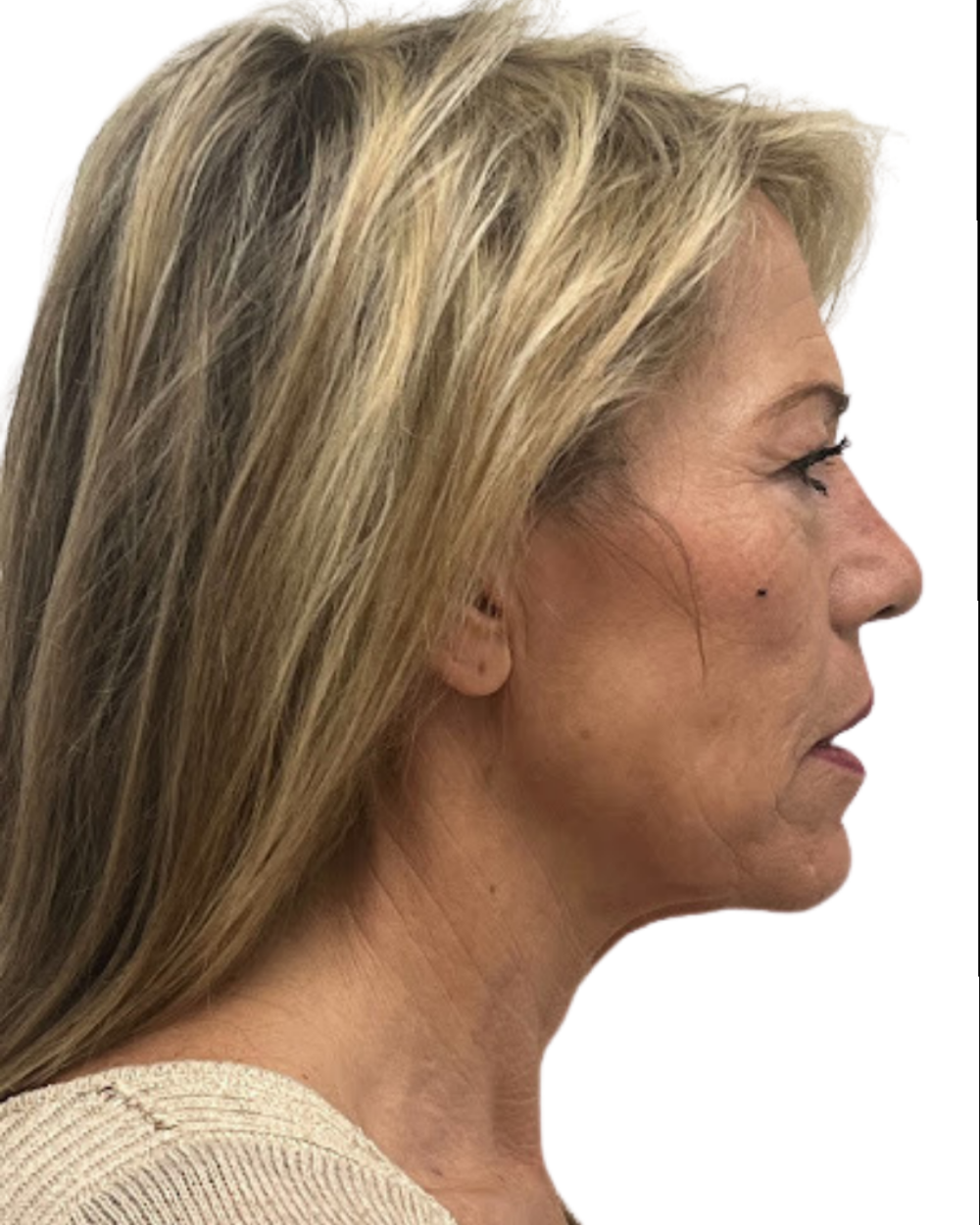 Facelift with Upper & Lower Bleph