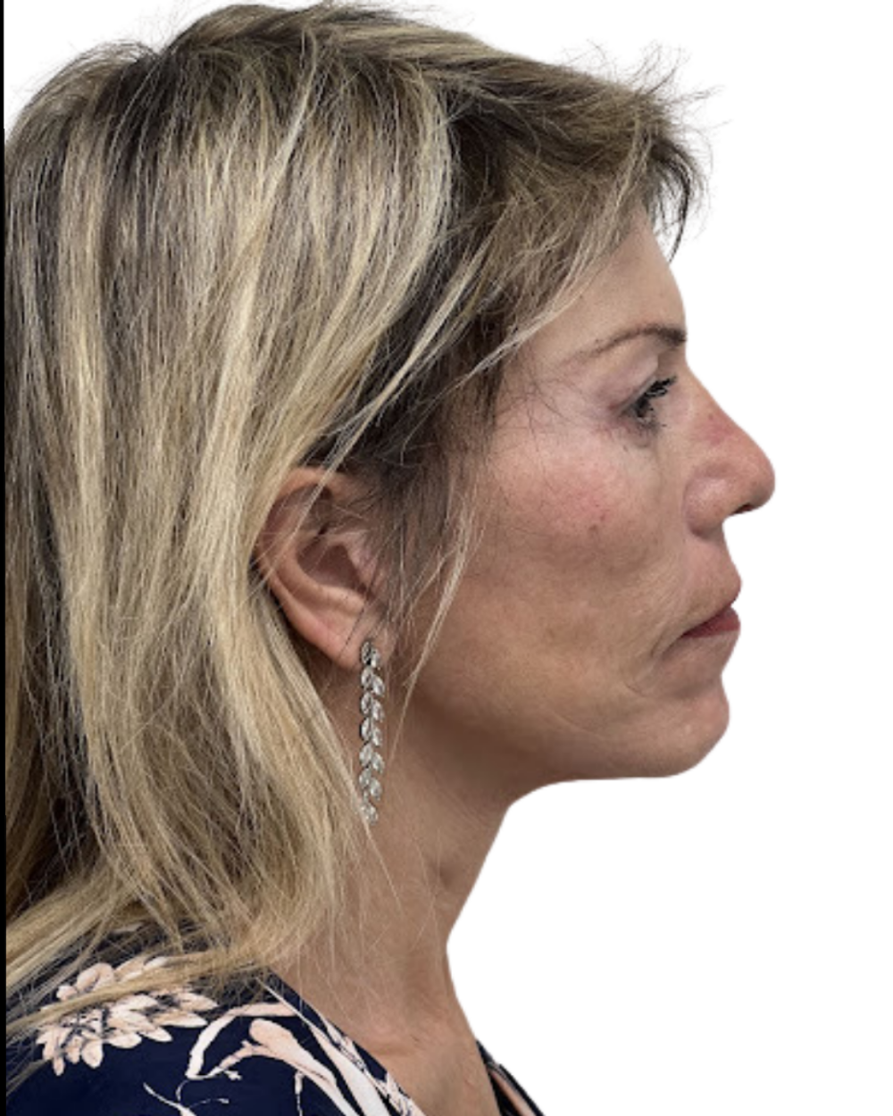 Facelift with Upper & Lower Bleph