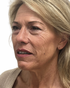 Le Spa Plastic Surgery Before and After Photos