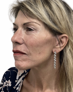 Le Spa Plastic Surgery Before and After Photos