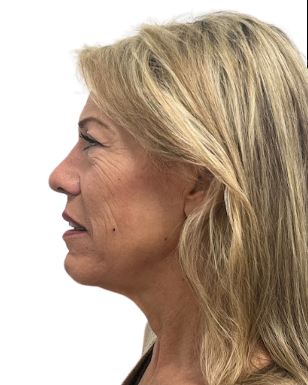 Facelift with Upper & Lower Bleph