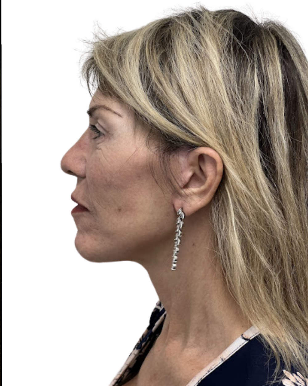 Facelift with Upper & Lower Bleph
