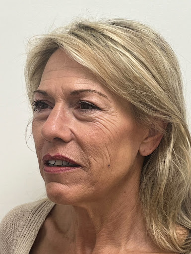 Facelift with Upper & Lower Bleph
