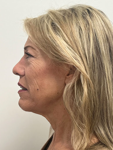 Facelift with Upper & Lower Bleph