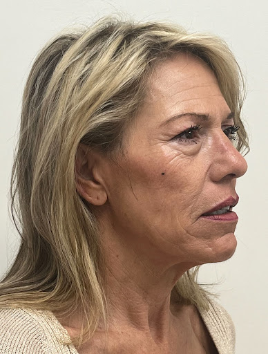 Facelift with Upper & Lower Bleph
