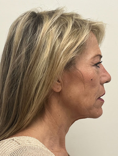 Facelift with Upper & Lower Bleph