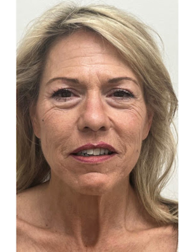 Facelift with Upper & Lower Bleph