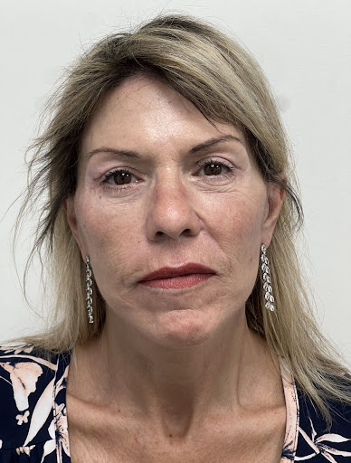 Facelift with Upper & Lower Bleph
