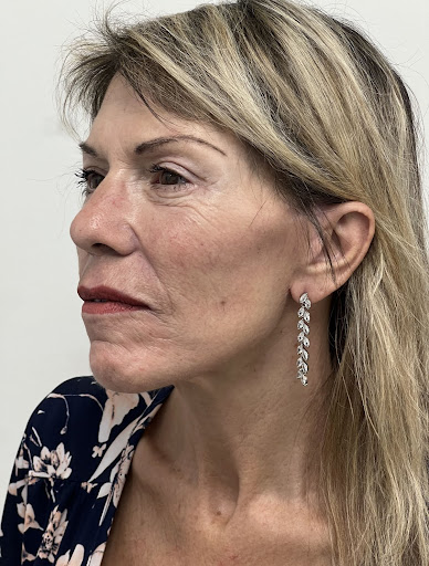 Facelift with Upper & Lower Bleph